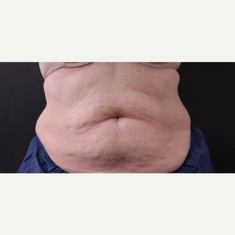 62 year old woman treated with CoolSculpting before 3221057