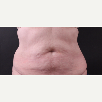 62 year old woman treated with CoolSculpting after 3221057