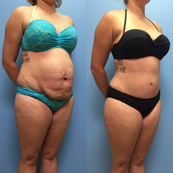 30 year-old woman treated with Tummy Tuck and Lipo 360 before 3494915