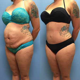 30 year-old woman treated with Tummy Tuck and Lipo 360 after 3494915