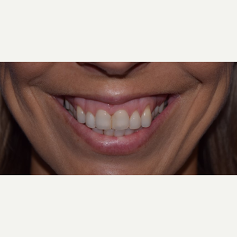 35-44 year old woman with "Gummy Smile" treated with Botox before 3345661