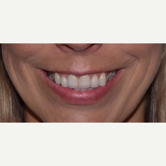35-44 year old woman with "Gummy Smile" treated with Botox after 3345661