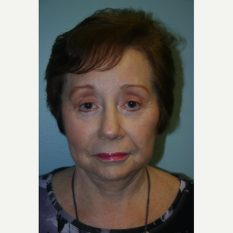72 Year Old Female Facelift, Browlift, and Eyelid Surgery after 3032435