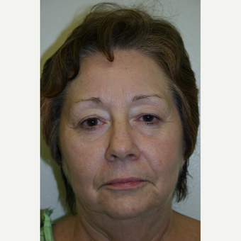 72 Year Old Female Facelift, Browlift, and Eyelid Surgery before 3032435