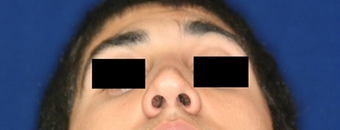 Before and after septoplatsy after 768216
