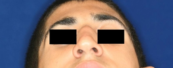 Before and after septoplatsy before 768216