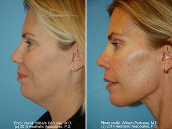 Neck Liposuction before 212290