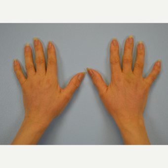 Hand Rejuvenation - Fat Transfer to Hands after 3465794