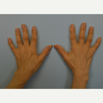 Hand Rejuvenation - Fat Transfer to Hands before 3465794