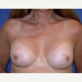 MTF Breast Augmentation after 1984072