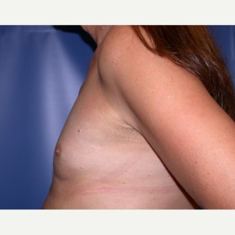 MTF Breast Augmentation 1984072