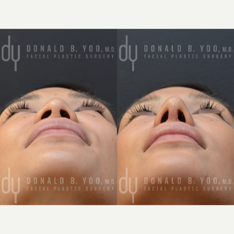 Revision Asian Rhinoplasty before 3477452