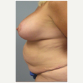 47 year old woman treated with Mommy Makeover after 3680033