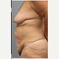 47 year old woman treated with Mommy Makeover before 3680033