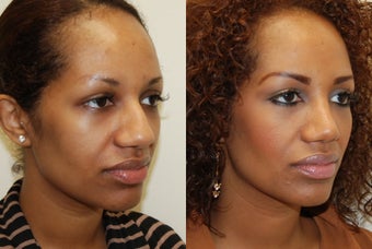African Rhinoplasty Surgery. 1 month post-op. before 754368