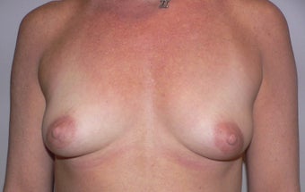 Breast Augmenation before 943702