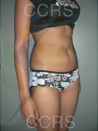 VASER lipo - 25 yrs old model (abdomen & flanks) before 636095