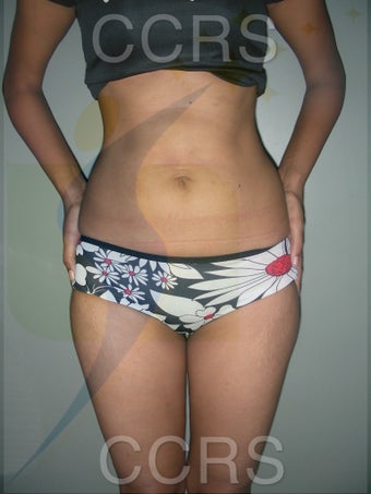 VASER lipo - 25 yrs old model (abdomen & flanks) 636095