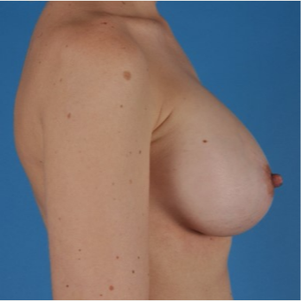 25-34 year old woman treated with Breast Augmentation after 3844192