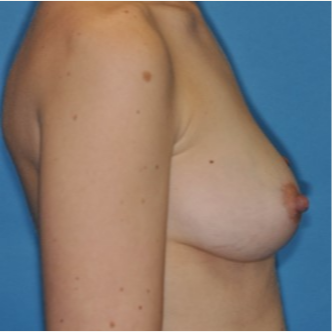 25-34 year old woman treated with Breast Augmentation before 3844192