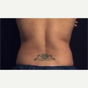 25-34 year old woman treated with CoolSculpting after 2010032
