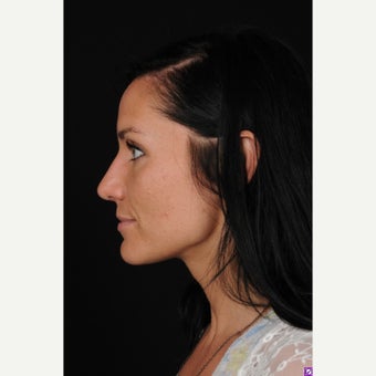 18-24 year old woman treated with Rhinoplasty after 1550956