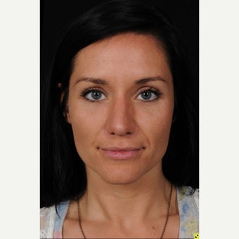 18-24 year old woman treated with Rhinoplasty 1550956