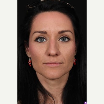 18-24 year old woman treated with Rhinoplasty 1550956