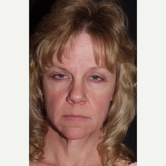 52 year old woman seeking more youthful appearance before 3481140
