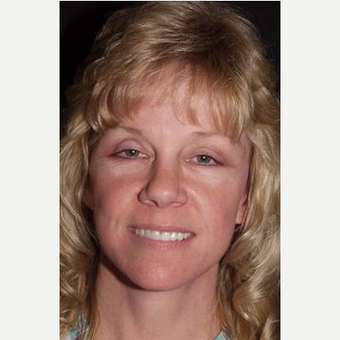 52 year old woman seeking more youthful appearance after 3481140