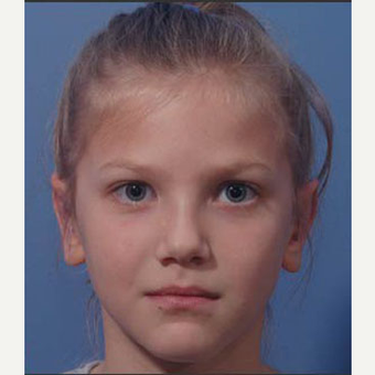17 or under year old woman treated with Ear Surgery after 3711717