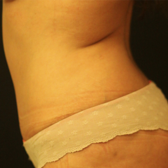 35-44 year old woman treated with Tummy Tuck after 3764727