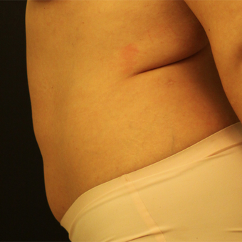 35-44 year old woman treated with Tummy Tuck before 3764727