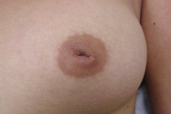27 Year Old Female Treated for Grade 3 Inverted Nipples before 1208837