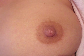 27 Year Old Female Treated for Grade 3 Inverted Nipples after 1208837