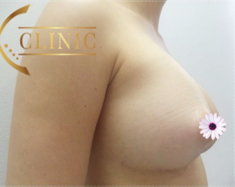35-44 year old woman treated with Breast Augmentation after 3765986