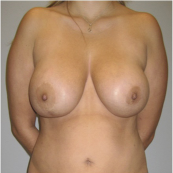 37 year old woman treated with Mommy Makeover before 3679988