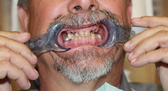 All-on-4 Dental Implants before 1138374