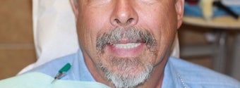 All-on-4 Dental Implants after 1138374