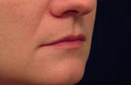 Restylane for Lip Enhancement before 53755