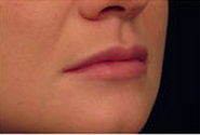 Restylane for Lip Enhancement after 53755