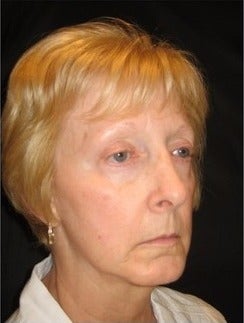 55-64 year old woman treated with Non Surgical Face Lift before 3181334