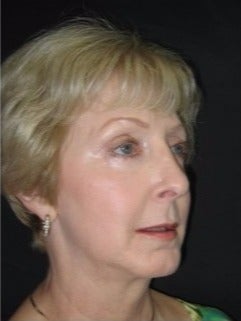 55-64 year old woman treated with Non Surgical Face Lift after 3181334