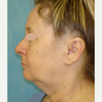 55-64 year old woman treated with Facelift before 3703965