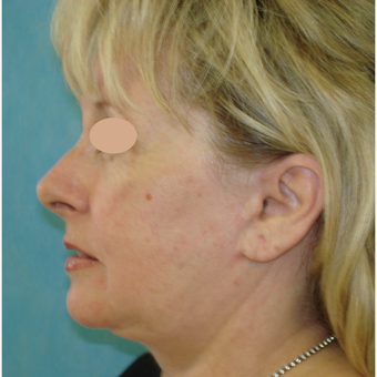 55-64 year old woman treated with Facelift after 3703965