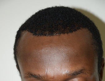 Surgical Hairline Advancement/Forehead Shortening Procedure 1282727
