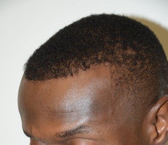 Surgical Hairline Advancement/Forehead Shortening Procedure after 1282727