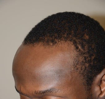 Surgical Hairline Advancement/Forehead Shortening Procedure before 1282727