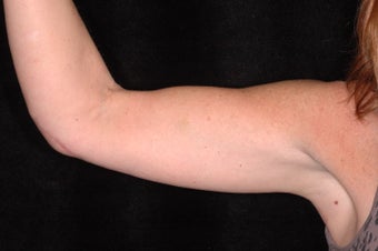 Brachioplasty for 54 year old female 1042416