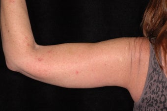 Brachioplasty for 54 year old female after 1042416